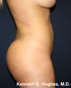 Butt Implants Before & After Patient #8176