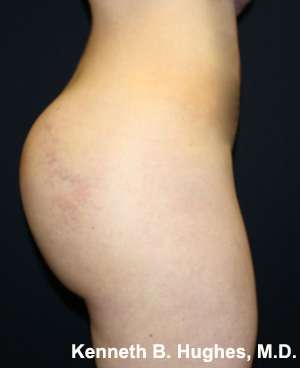 Butt Implants Before & After Patient #8179