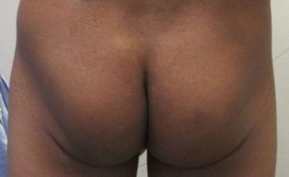 Butt Implants Before & After Patient #8186