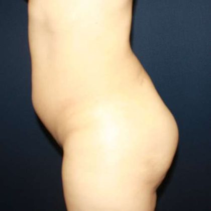 Butt Implants Before & After Patient #8201
