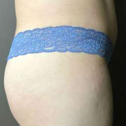 Butt Implants Before & After Patient #8207