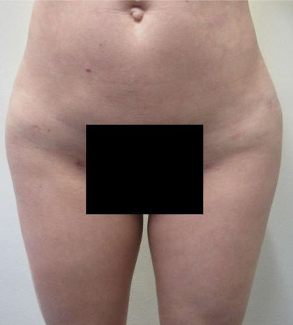 Butt Implants Before & After Patient #8219