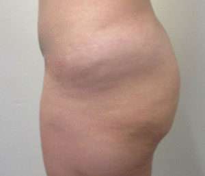 Butt Implants Before & After Patient #8224