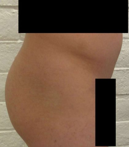 Butt Implants Before & After Patient #8227