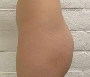 Butt Implants Before & After Patient #8230