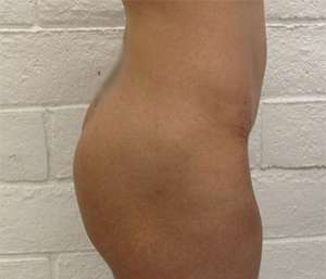 Butt Implants Before & After Patient #8233