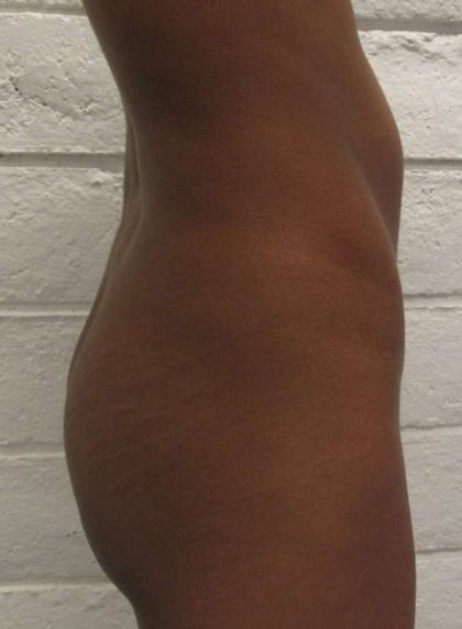Butt Implants Before & After Patient #8241