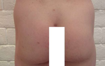 Butt Implants Before & After Patient #8244