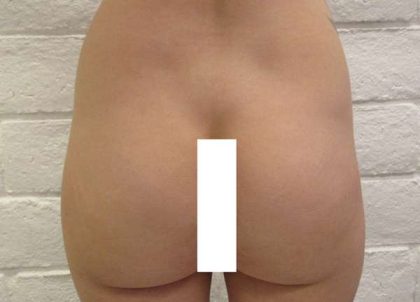 Butt Implants Before & After Patient #8247