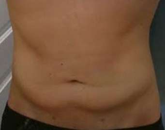 Bodytite Before & After Patient #6111