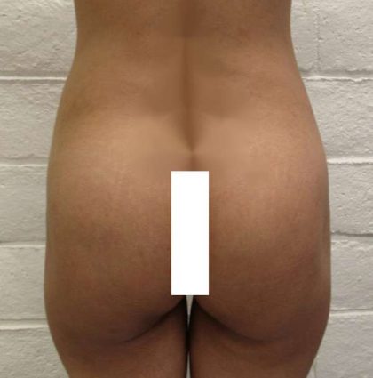 Butt Implants Before & After Patient #8250