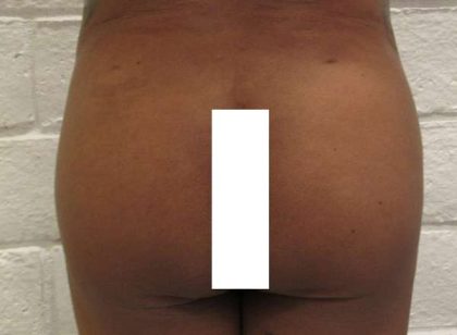 Butt Implants Before & After Patient #8253