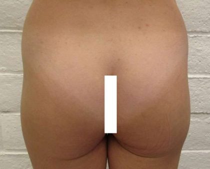 Butt Implants Before & After Patient #8256