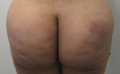 Butt Implants Before & After Patient #8274