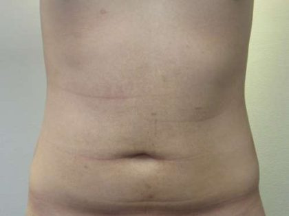 Bodytite Before & After Patient #6114