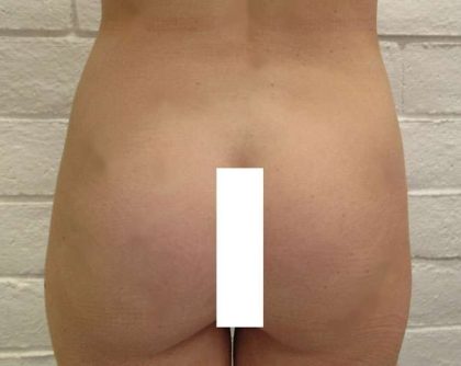 Butt Implants Before & After Patient #8285