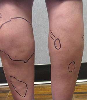 Calf Liposuction Before & After Patient #8288