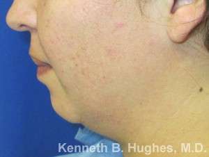 Chin Implant Before & After Patient #8291