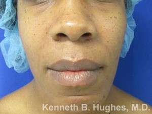 Chin Implant Before & After Patient #8296