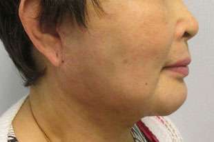 Chin Implant Before & After Patient #8299