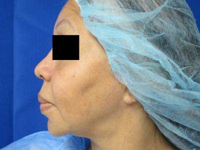 Chin Implant Before & After Patient #8307