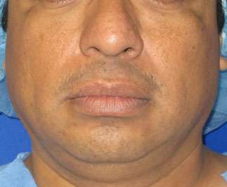 Chin Liposuction Before & After Patient #8335