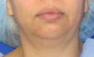 Chin Liposuction Before & After Patient #8340