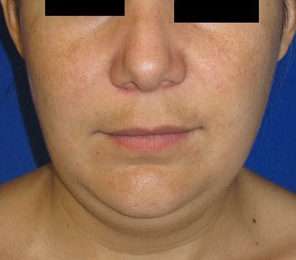 Chin Liposuction Before & After Patient #8345