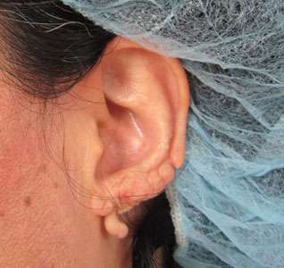 Ear Correction Before & After Patient #8354