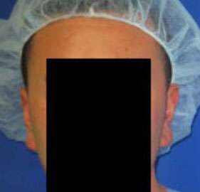 Ear Correction Before & After Patient #8357