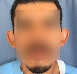 Ear Correction Before & After Patient #8360