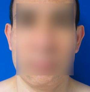 Ear Correction Before & After Patient #8363