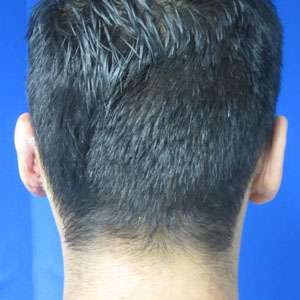 Ear Correction Before & After Patient #8366