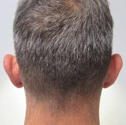 Ear Correction Before & After Patient #8373