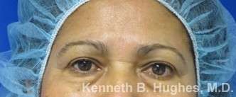 Eyelid Surgery Before & After Patient #8376