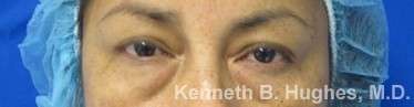 Eyelid Surgery Before & After Patient #8379