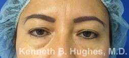 Eyelid Surgery Before & After Patient #8382