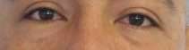 Eyelid Surgery Before & After Patient #8388