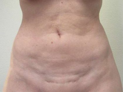 Abdomen Before & After Patient #5866