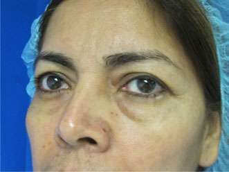 Eyelid Surgery Before & After Patient #8409