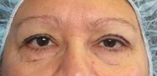 Eyelid Surgery Before & After Patient #8415