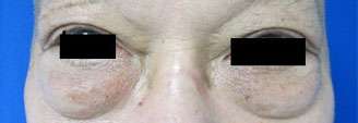 Eyelid Surgery Before & After Patient #8418