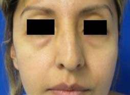 Eyelid Surgery Before & After Patient #8424