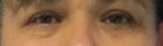 Eyelid Surgery Before & After Patient #8439