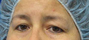 Eyelid Surgery Before & After Patient #8448