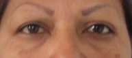 Eyelid Surgery Before & After Patient #8451