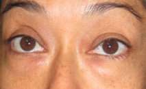 Eyelid Surgery Before & After Patient #8457