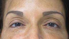Eyelid Surgery Before & After Patient #8460
