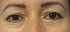 Eyelid Surgery Before & After Patient #8463