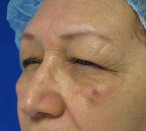 Eyelid Surgery Before & After Patient #8466